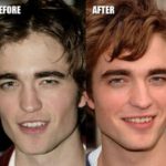 Robert Pattinson Plastic Surgery Before And After