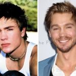Chad Michael Murray Plastic Surgery Before and After