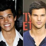 Taylor Lautner Plastic Surgery Before and After