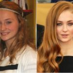 Sophie Turner Plastic Surgery Before and After