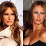 Melania Trump Plastic Surgery Before and After