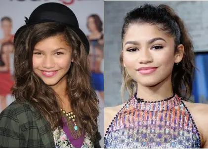 zendaya plastic surgery