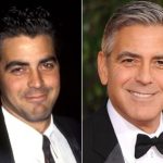 George Clooney Plastic Surgery Before and After