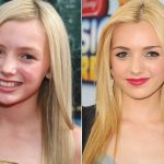 Peyton List Plastic Surgery Before and After