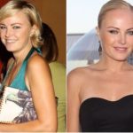 Malin Akerman Plastic Surgery Before and After