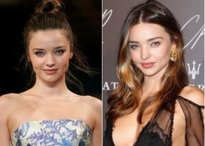 Miranda Kerr Plastic Surgery Before and After - Celebrity Surgeries